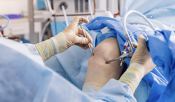 Arthroscopy