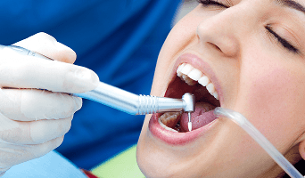 Dental Deep Cleaning (Scaling & Root Planing)