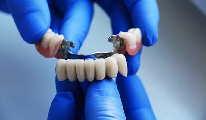 Dental Bridges