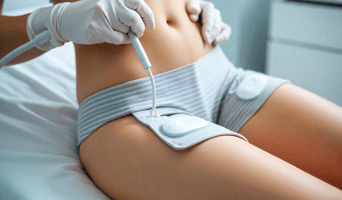 Laser Liposuction (Laser Lipolysis)