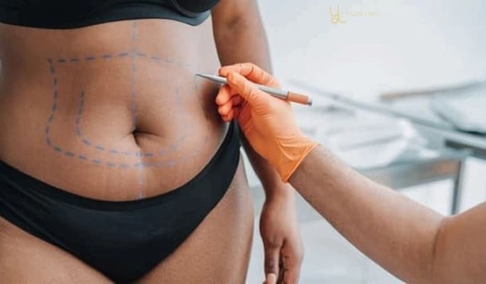 Liposuction