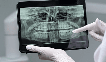 Panoramic X Ray