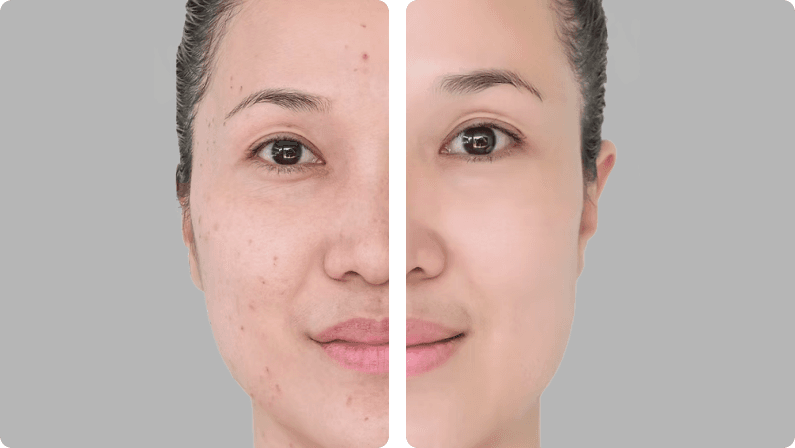 Accutane before and after