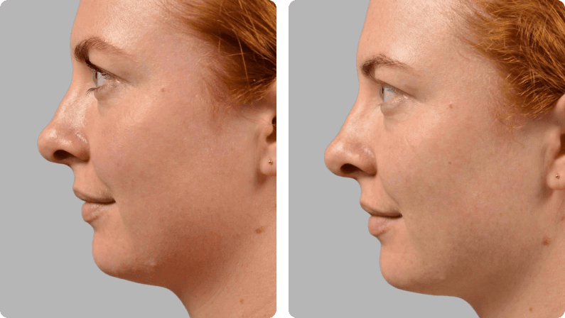 Halo Laser before and after