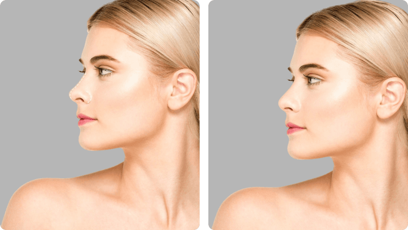 Septoplasty before and after