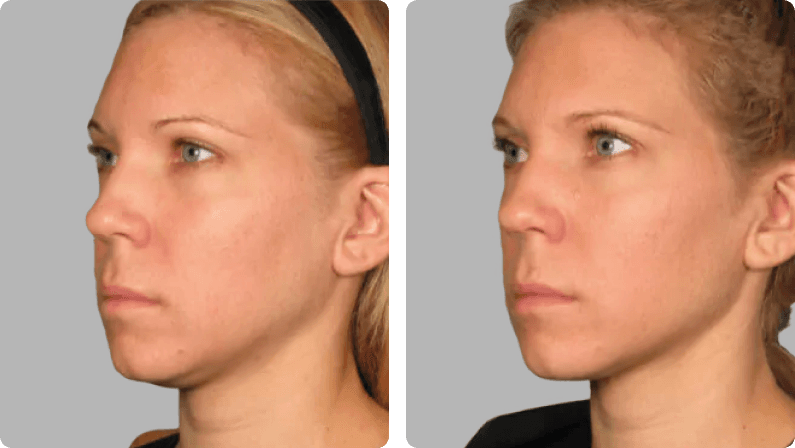 Ultherapy before and after