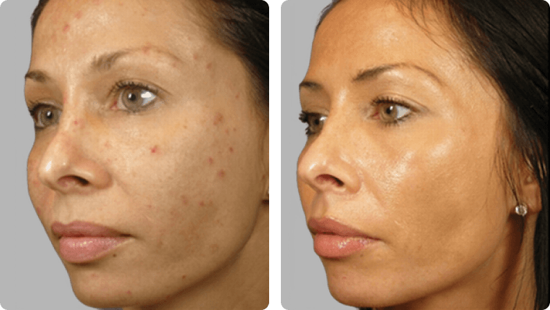 VI Peel before and after