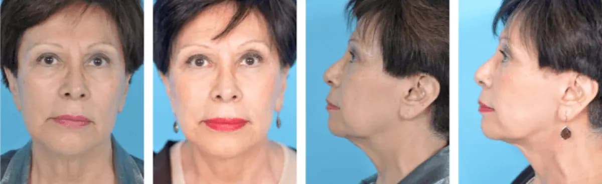 Plastic Surgery Chicago - Image 3