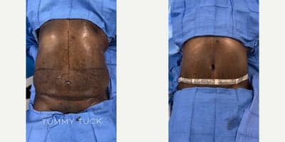 Case 1 - Man in his mid 50s treated with Tummy Tuck