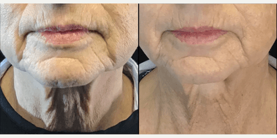 Case 10191 - 65-74 year old woman treated with Ultherapy