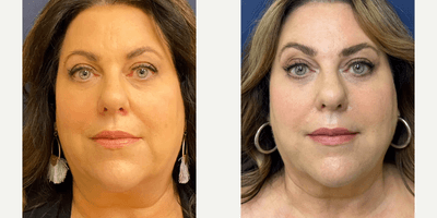 Case 10192 - Woman treated with Liposuction, Ultherapy, Morpheus8, Voluma