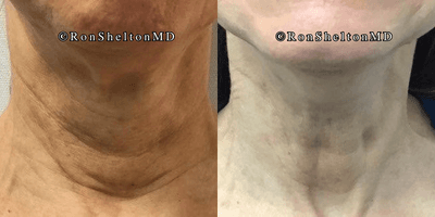 Case 10193 - 65-74 year old woman treated with Ultherapy, Sofwave, Neck Lift, Skin Tightening