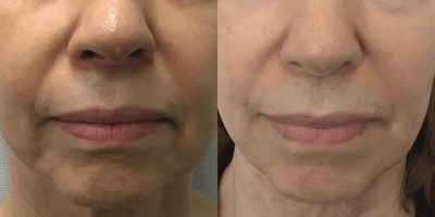 Case 10194 - 65-74 year old woman treated with Sofwave, Ultherapy, Skin Tightening