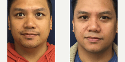 Case 10195 - Man treated with Liposuction, FaceTite, Ultherapy