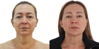 Case 10196 - 45-54 year old woman treated with Ultherapy