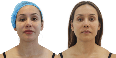 Case 10197 - 45-54 year old woman treated with Ultherapy