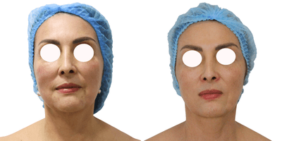 Case 10198 - 45-54 year old woman treated with Ultherapy