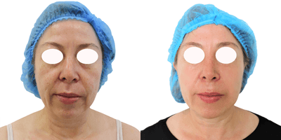 Case 10199 - 45-54 year old woman treated with Ultherapy