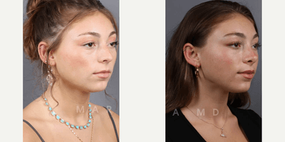 Case 10381 - Woman treated with Rhinoplasty, Septoplasty