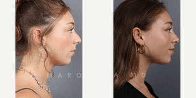 Case 10382 - Woman treated with Rhinoplasty, Septoplasty