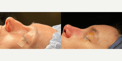 Case 10383 - Woman treated with Rhinoplasty, Septoplasty