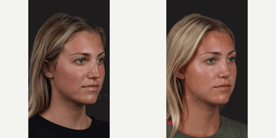 Case 10384 - Woman treated with Rhinoplasty, Septoplasty