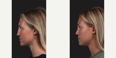 Case 10385 - Woman treated with Rhinoplasty, Septoplasty