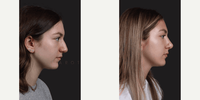 Case 10386 - Woman treated with Rhinoplasty, Septoplasty