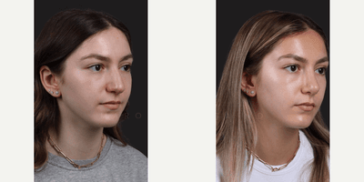 Case 10387 - Woman treated with Rhinoplasty, Septoplasty