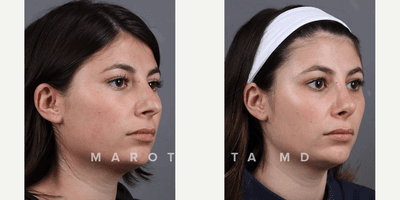 Case 10388 - Woman treated with Septoplasty