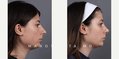 Case 10389 - Woman treated with Septoplasty