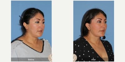 Case 10500 - 47 year old woman treated with Deep Plane Facelift, Neck Lift, Brow Lift, Buccal Fat Removal, MACS Facelift