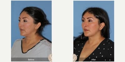 Case 10501 - 47 year old woman treated with Deep Plane Facelift, Neck Lift, Brow Lift, Buccal Fat Removal, MACS Facelift