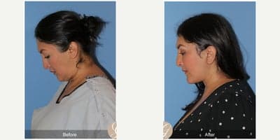 Case 10502 - 47 year old woman treated with Deep Plane Facelift, Neck Lift, Brow Lift, Buccal Fat Removal, MACS Facelift