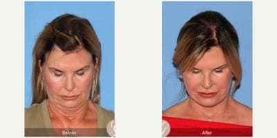 Case 10503 - 66 year old woman treated with Deep Plane Facelift, Facelift, Neck Lift, MACS Facelift