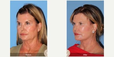 Case 10504 - 66 year old woman treated with Deep Plane Facelift, Facelift, Neck Lift, MACS Facelift