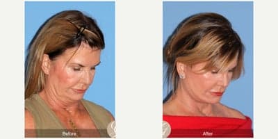 Case 10505 - 66 year old woman treated with Deep Plane Facelift, Facelift, Neck Lift, MACS Facelift