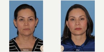Case 10506 - 51 year old woman treated with Deep Plane Facelift, Facelift, Neck Lift, Brow Lift, Facial Fat Transfer, MACS Facelift