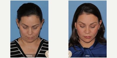 Case 10507 - 51 year old woman treated with Deep Plane Facelift, Facelift, Neck Lift, Brow Lift, Facial Fat Transfer, MACS Facelift