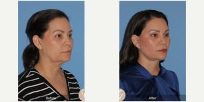 Case 10508 - 51 year old woman treated with Deep Plane Facelift, Facelift, Neck Lift, Brow Lift, Facial Fat Transfer, MACS Facelift