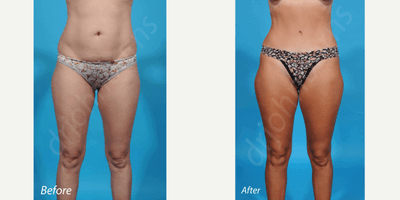 35-44 year old woman treated with Liposculpture