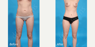 25-34 year old woman treated with Liposculpture