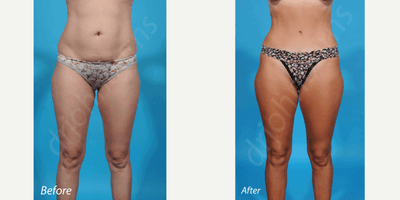 35-44 year old woman treated with Liposculpture