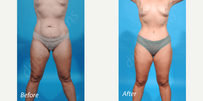 35-44 year old woman treated with Liposculpture