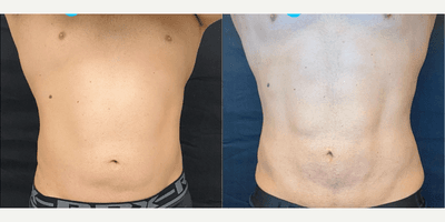 Man treated with A.T.L.A.S. Procedure and Renuvion Skin Tightening