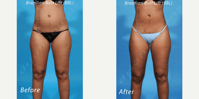 35-44 year old woman treated with Liposculpture