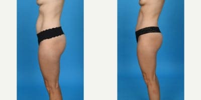 35-44 year old woman treated with Abdominal Etching, Diastasis Recti Repair, Drainless Tummy Tuck, Liposculpture, Liposuction, M