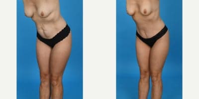 35-44 year old woman treated with Abdominal Etching, Diastasis Recti Repair, Drainless Tummy Tuck, Liposculpture, Liposuction, M