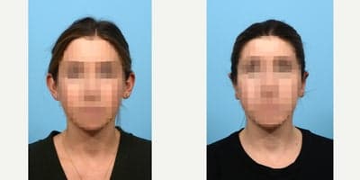 Case 11051 - 25-34 year old woman treated with Ear Surgery