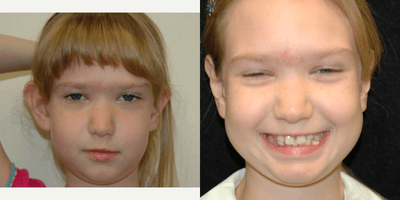 Case 11054 - 17 or under year old woman treated with Ear Surgery